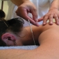 Acupunctura conform credintei chineze