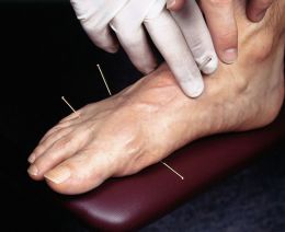 Cum functioneaza acupunctura