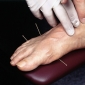 Cum functioneaza acupunctura