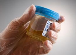 Cum poate influenta pH-ul urinar litiaza urinara