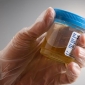 Cum poate influenta pH-ul urinar litiaza urinara